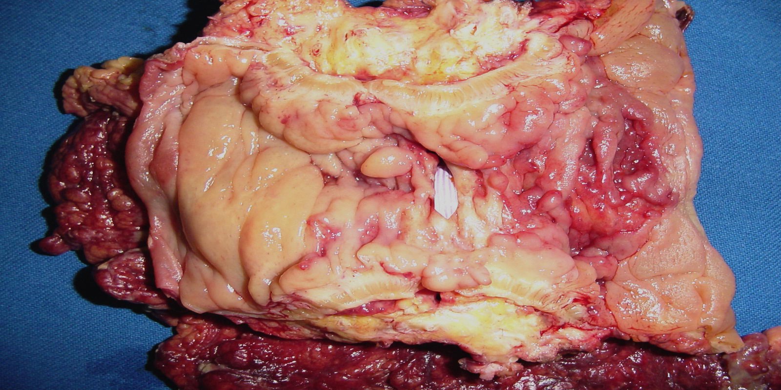 Caso Código 279A de Doença de Crohn 279A