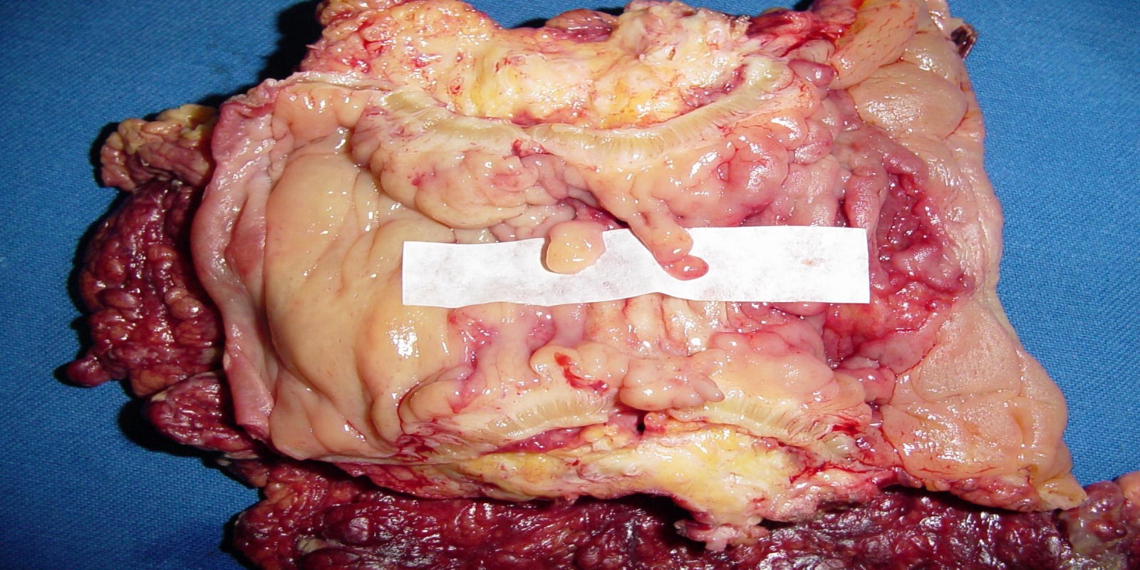 Caso Código 279B de Doença de Crohn 279B