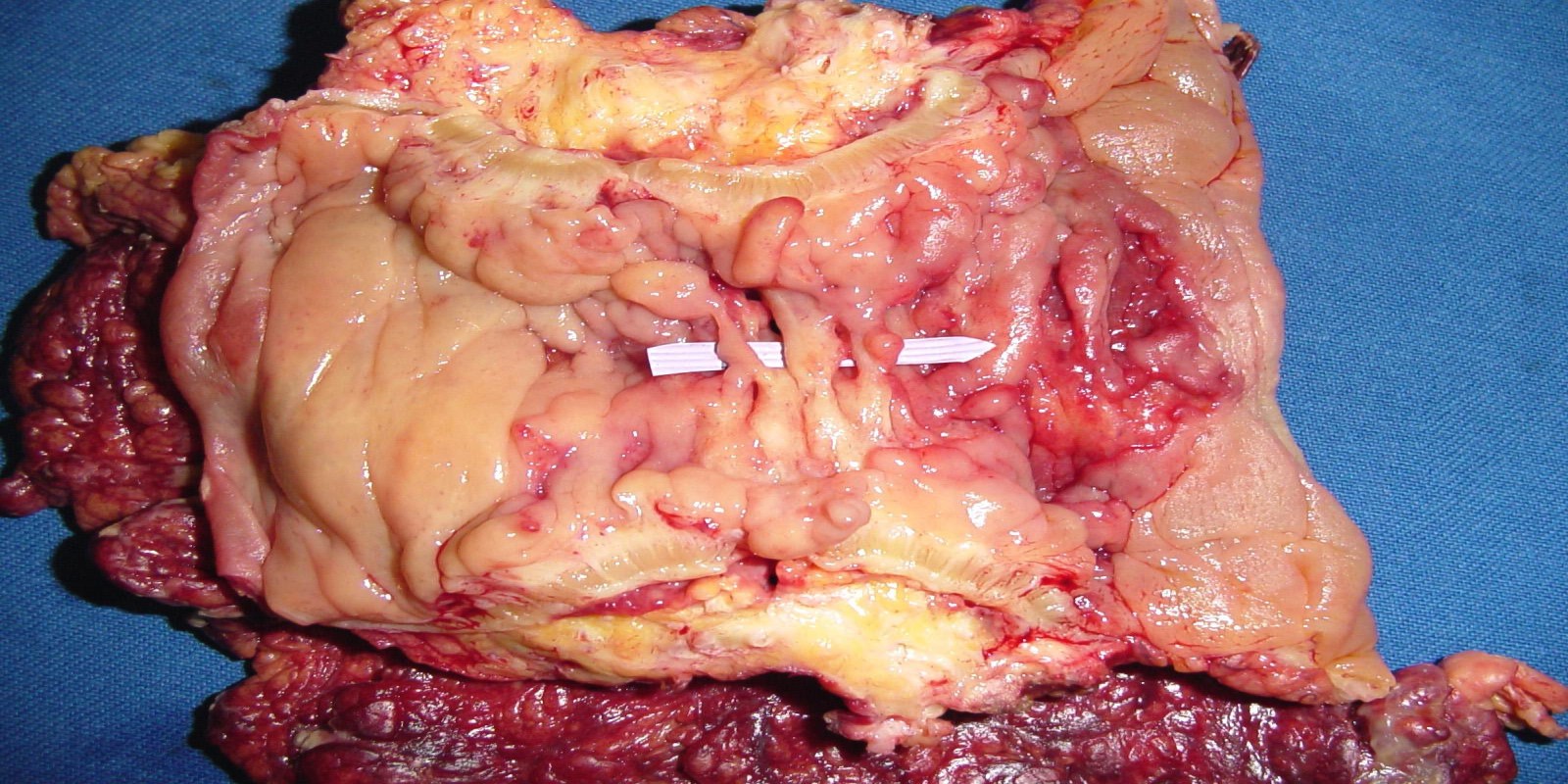 Caso Código 279C de Doença de Crohn 279C