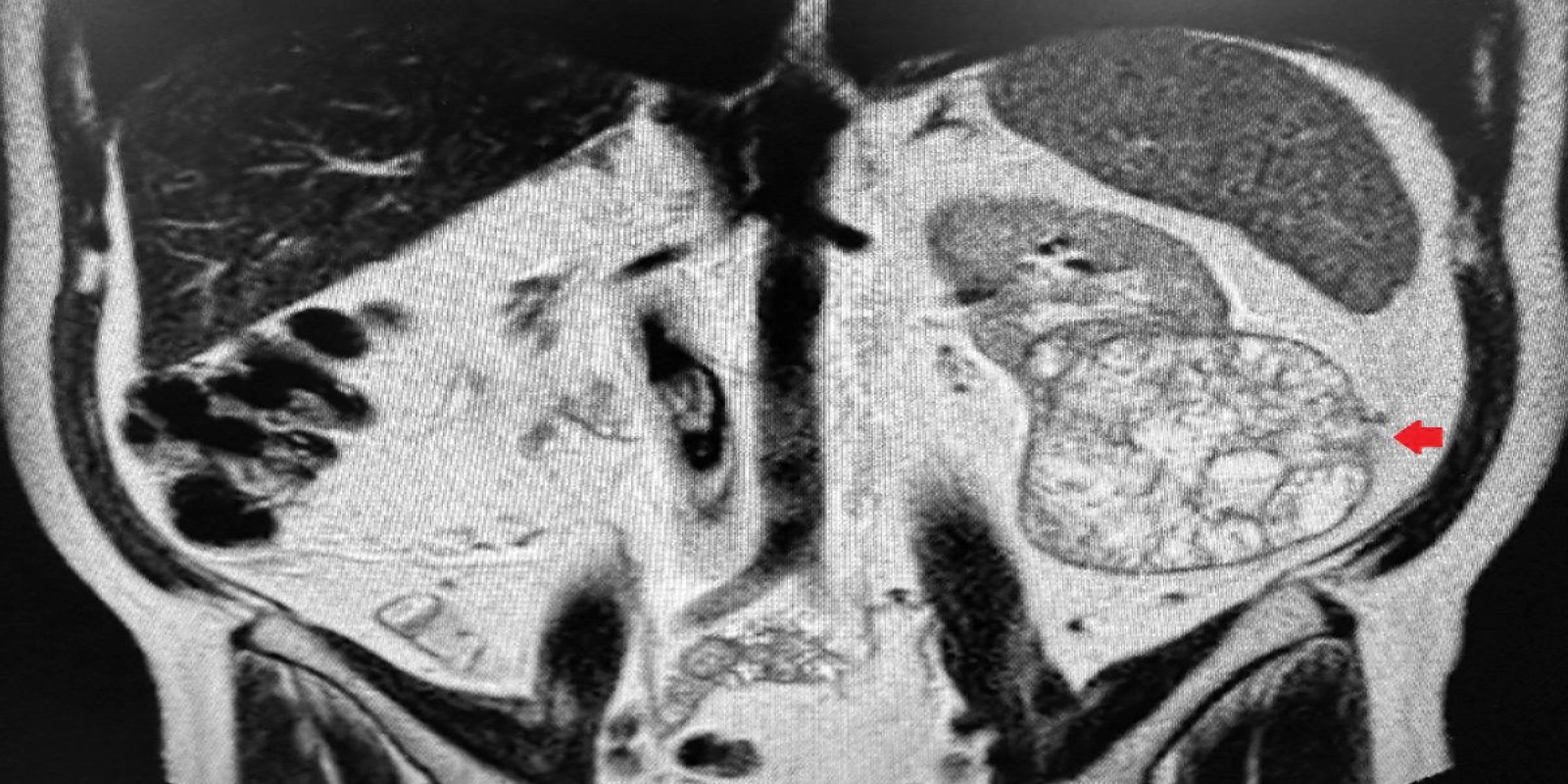 Caso Código 252A de Tumor de células claras 252A