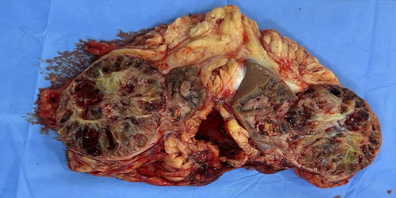 Caso Código 252B de Tumor de células claras 252B