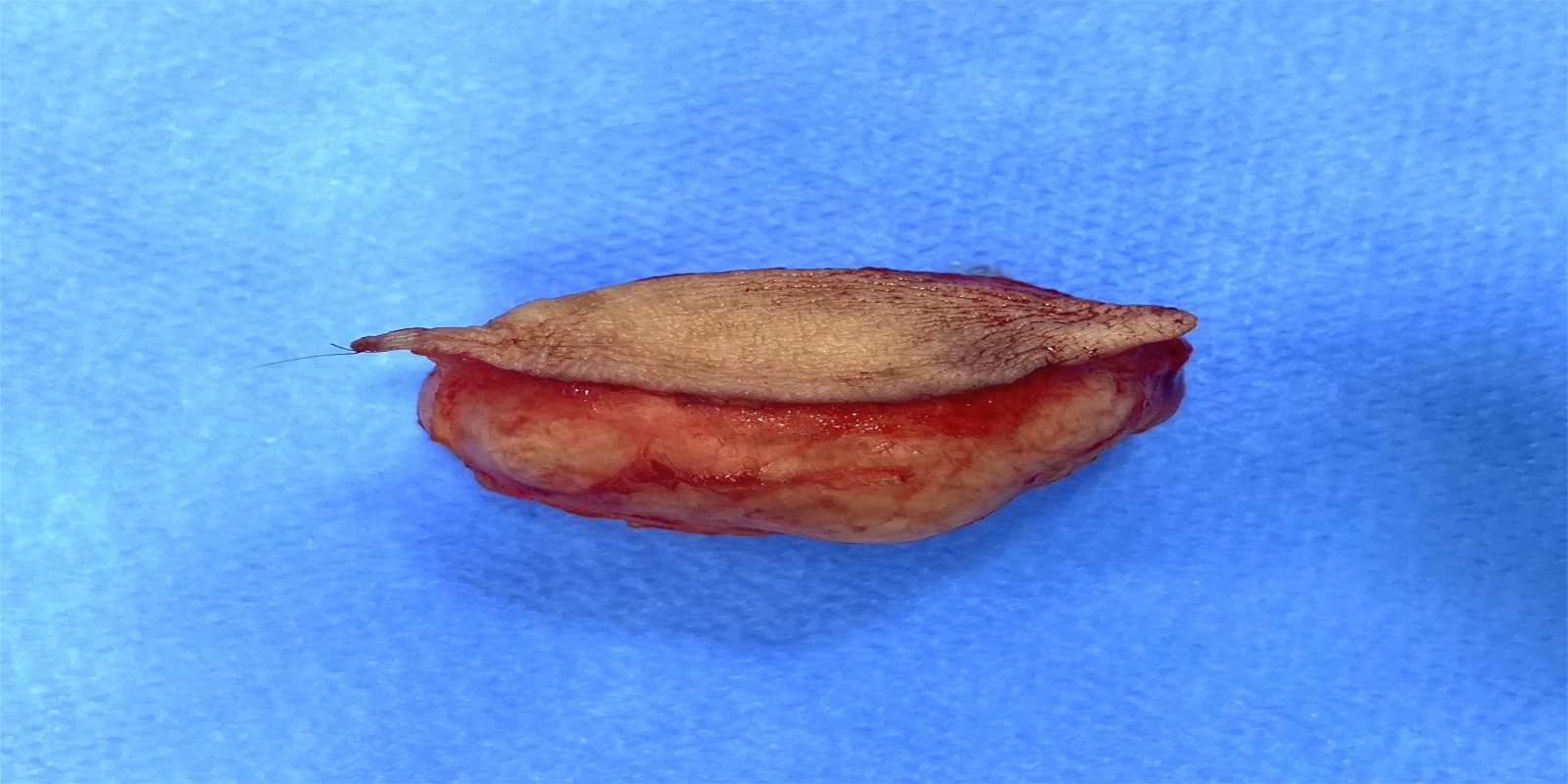 Caso Código 254A de Cisto Epidérmico 254A