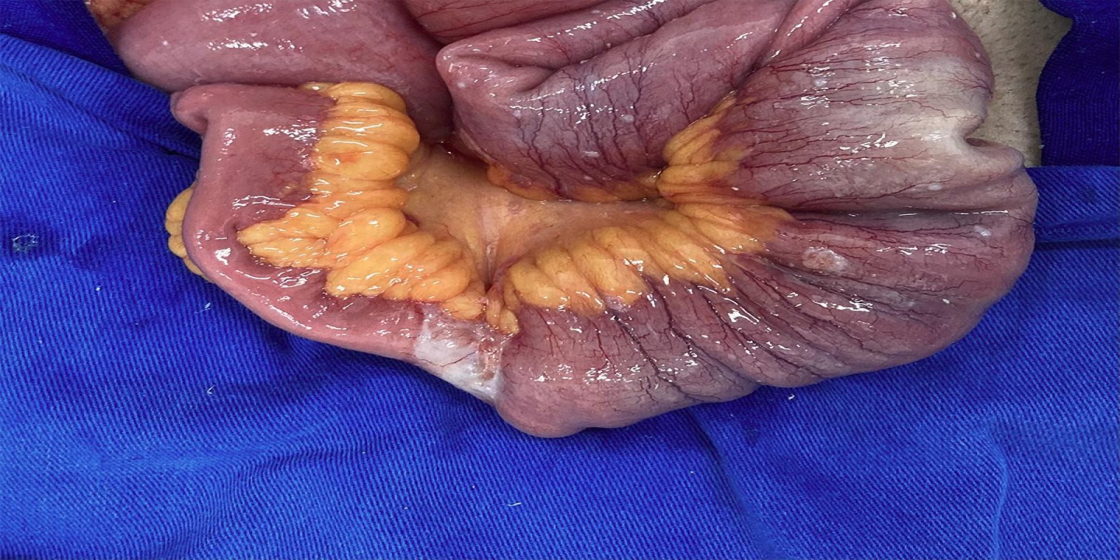 Caso Código 257A de Tumor neuroendócrino - Carcinóide 257A