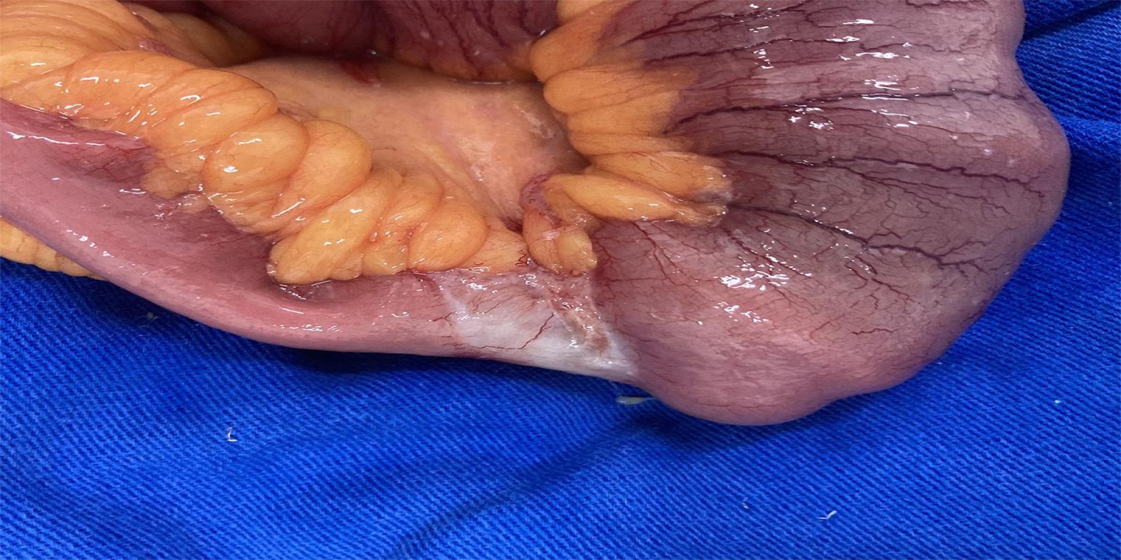 Caso Código 257B de Tumor neuroendócrino - Carcinóide 257B