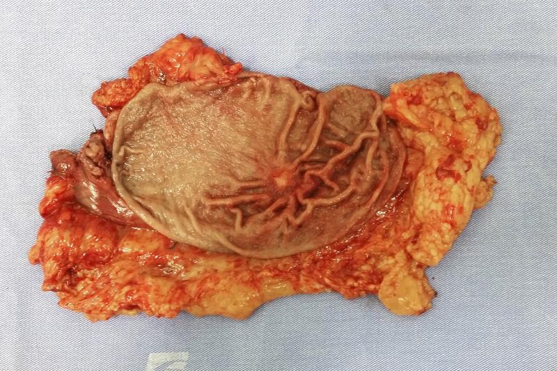 Adenocarcinoma de estômago