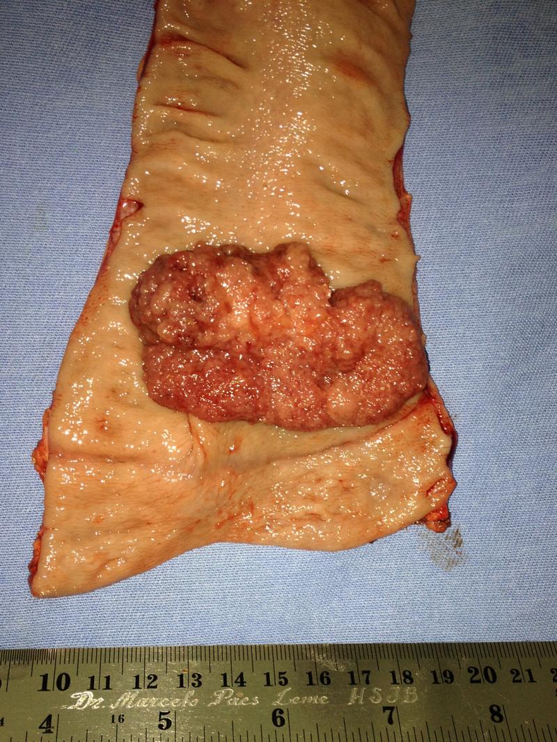 Adenoma viloso de reto