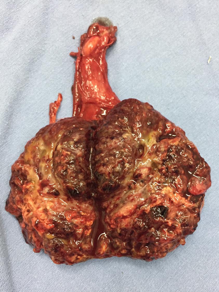 Neoplasia Testicular 