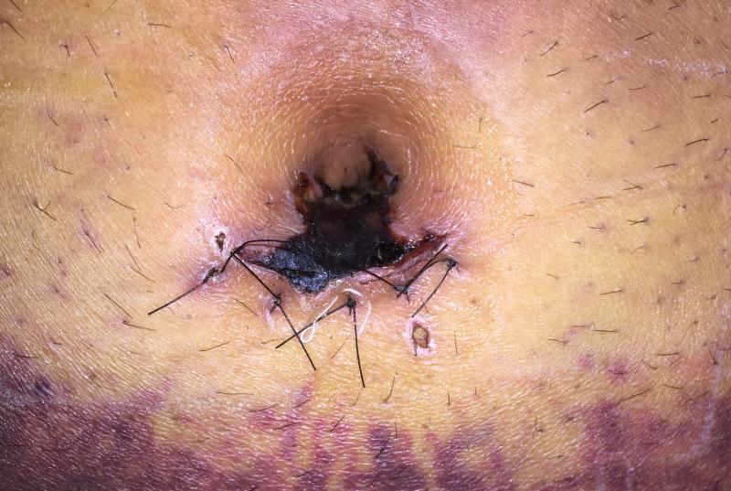 Necrose de epiderme em herniorrafia umbilica