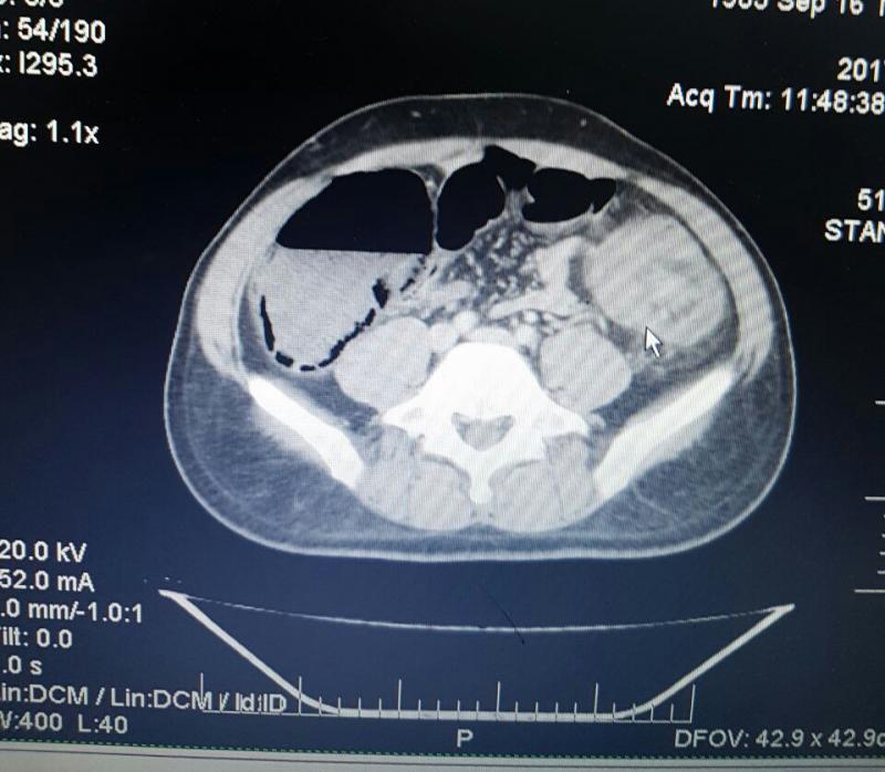 Intussuscepção Intestinal 