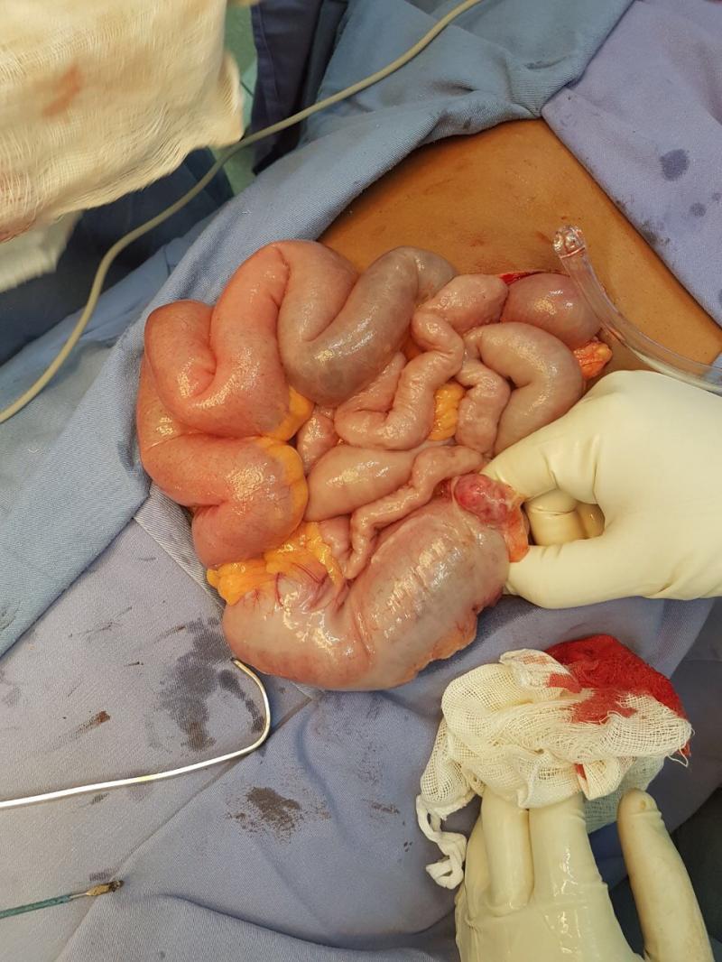 Intussuscepção Intestinal 