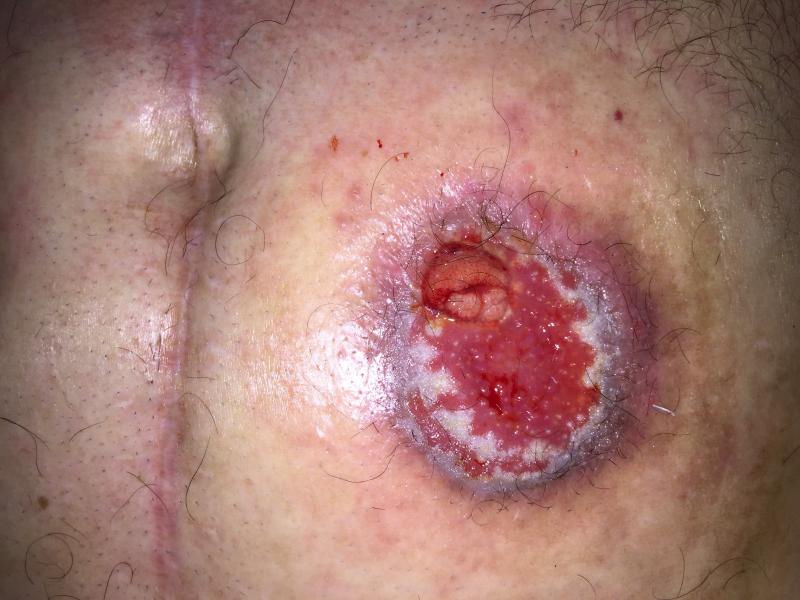 Dermatite grave peri ileostomia