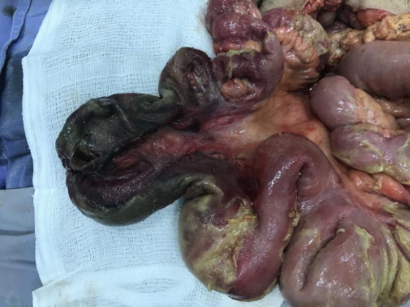 Necrose intestinal decorrente de hérnia inguinal estrangulada