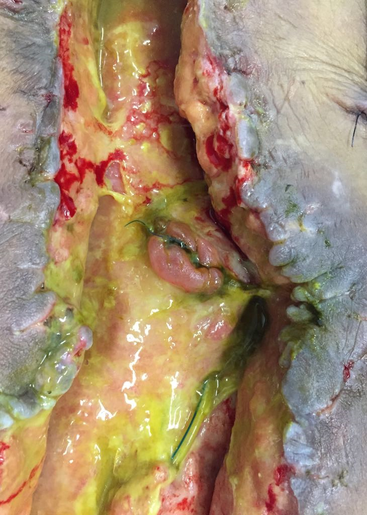 Deiscência de sutura intestinal