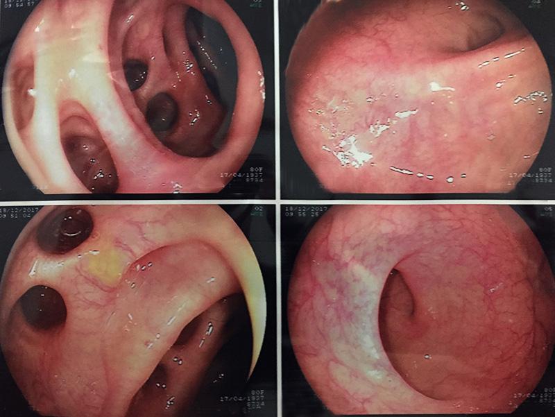 Colonoscopia - doença diverticular