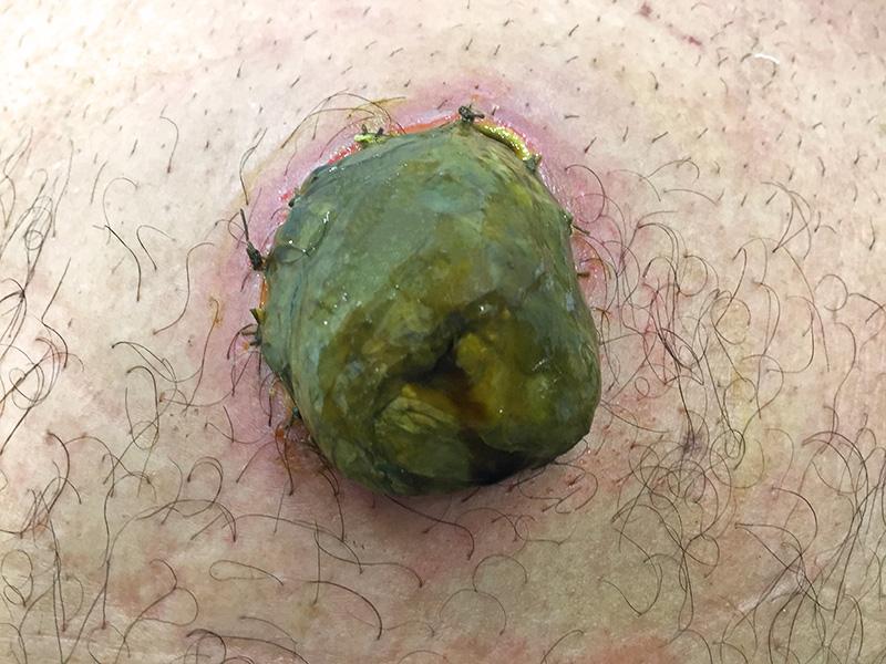 Necrose de ileostomia