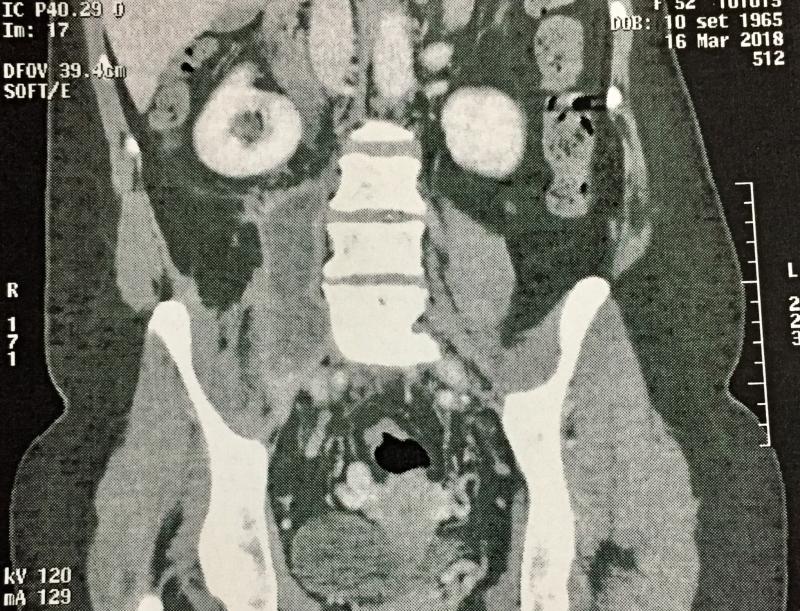 TC: abscesso do psoas direito