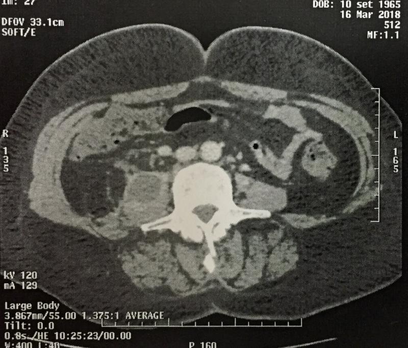 TC: abscesso do psoas direito