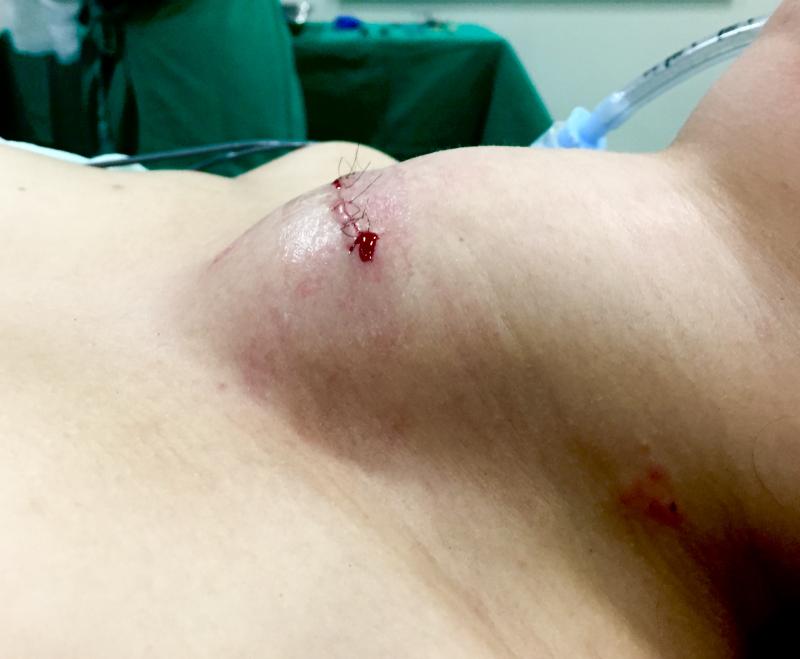 Hematoma pós tireoidectomia