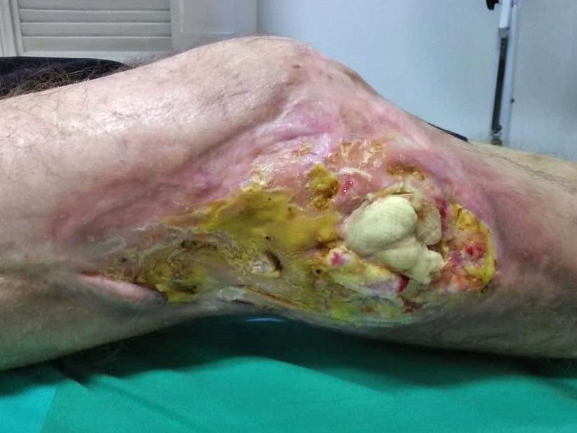 Carcinoma espino celular de perna