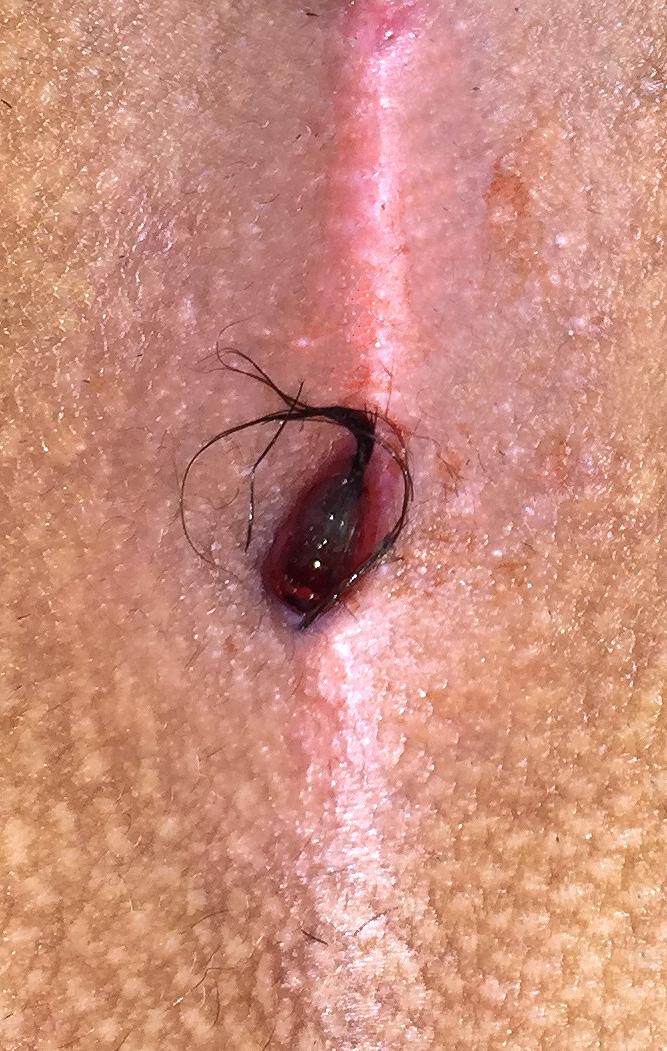 Cisto pilonidal