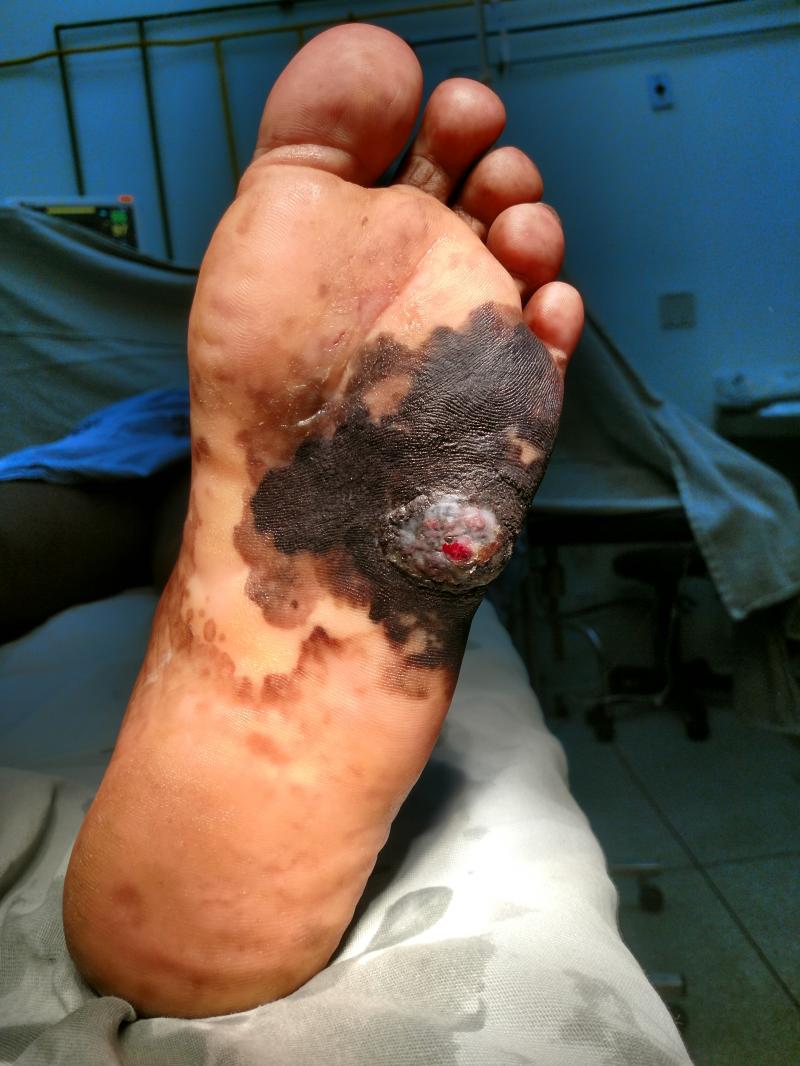 Melanoma lentiginoso acral