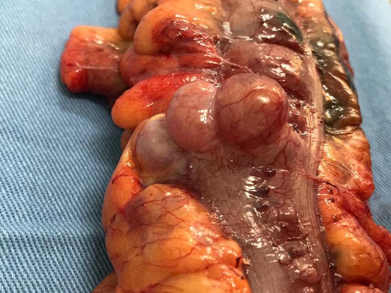 Doença diverticular