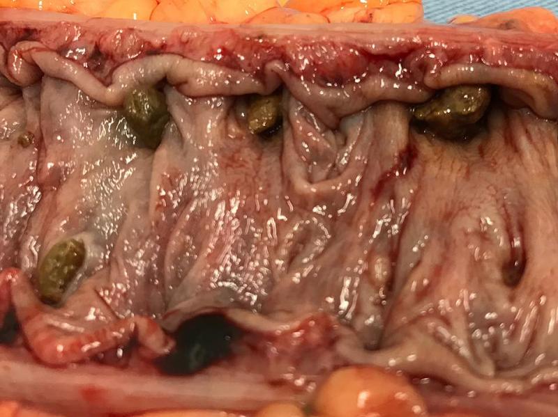 Doença diverticular