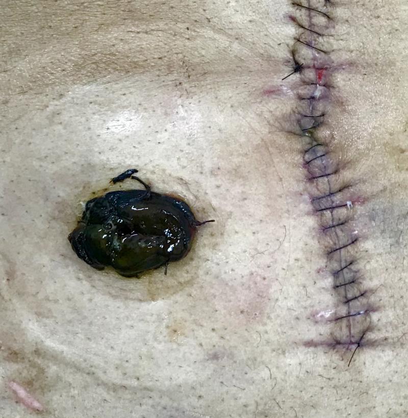 Necrose de Ileostomia Terminal associada ao uso de altas doses de aminas vasoativas.