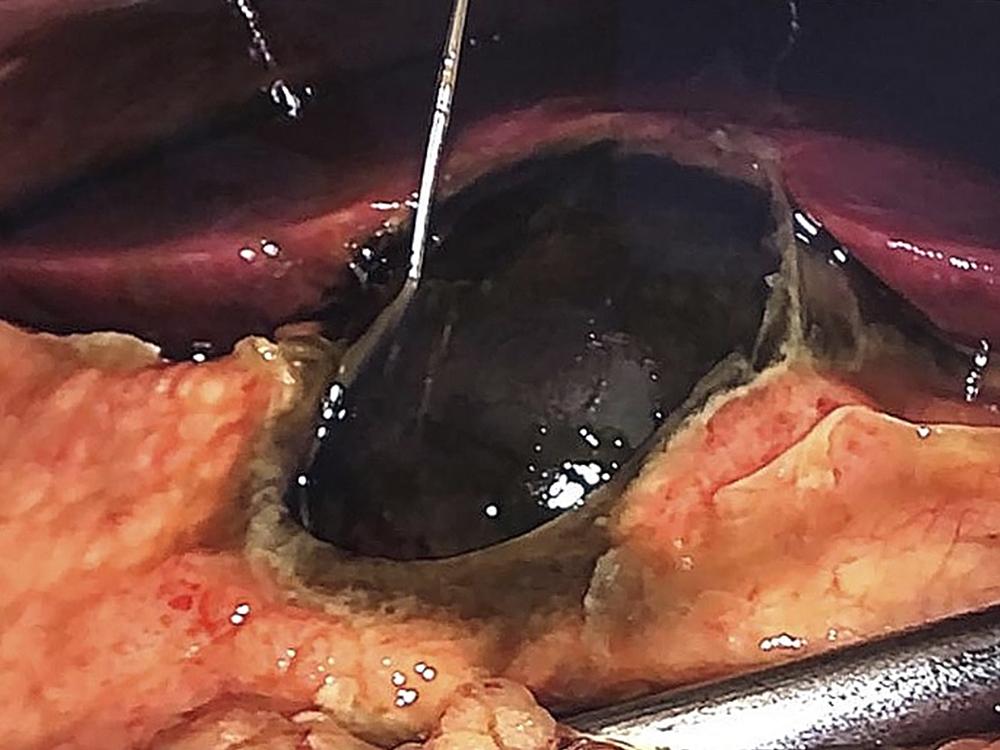 Necrose de vesícula biliar