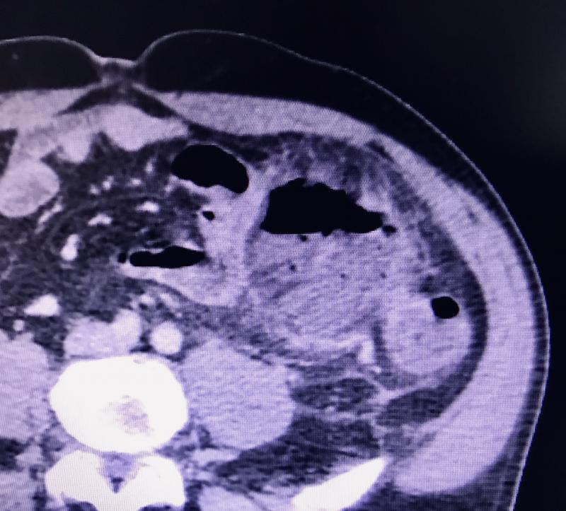 Abscesso Pericolônico associado a Diverticulite Aguda. 