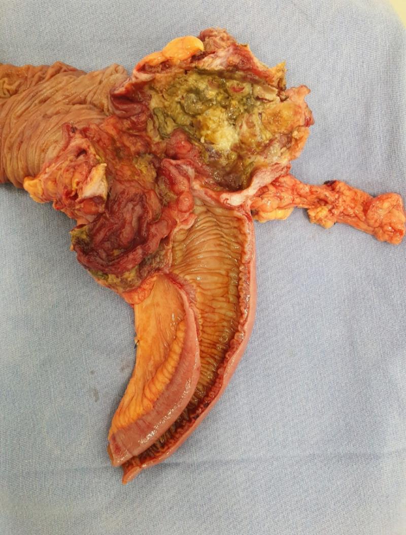 Tumor de Ceco (Colectomia Direita)