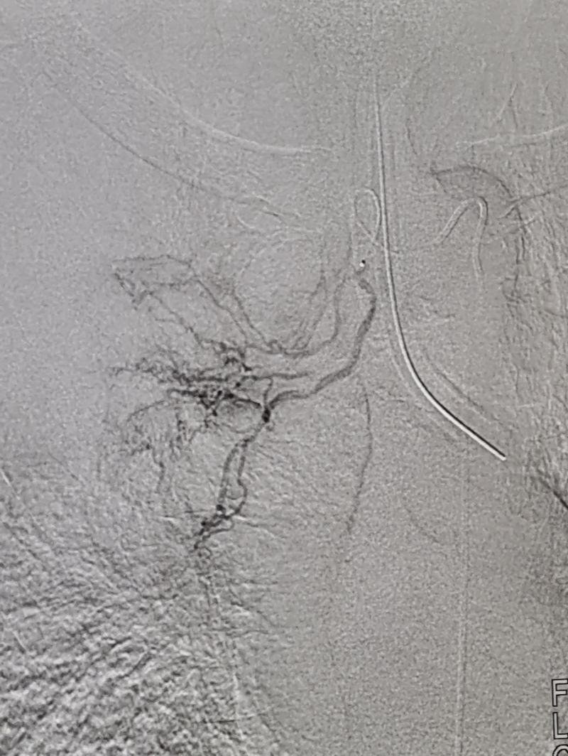 Hemoptise Maciça associada a câncer de pulmão tratada com Angioembolizacão de Artéria Bronquica Direita