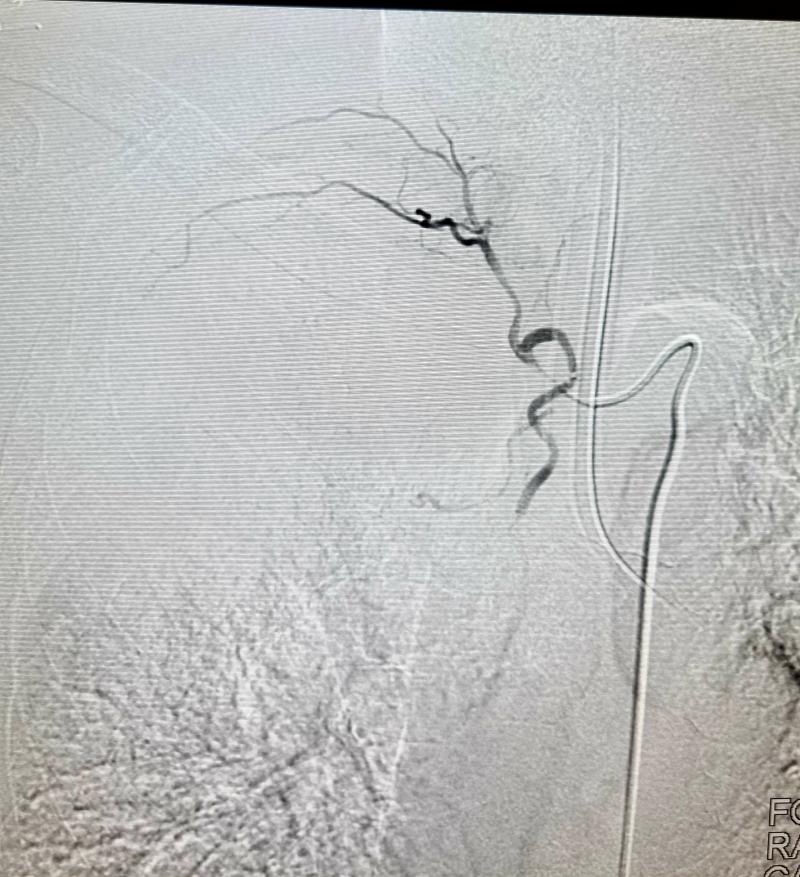 Hemoptise Maciça associada a câncer de pulmão tratada com Angioembolizacão de Artéria Bronquica Direita