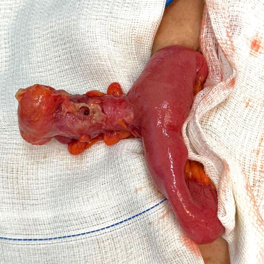 Caso Código 258A de Divertículo de Meckel - Case Code 258A of Meckel Diverticulum