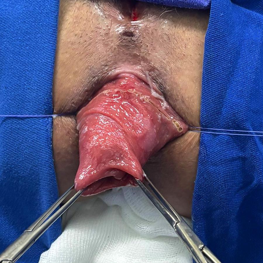 Caso Código 259A de Prolapso Retal - Case Code 259A of Rectal Prolapse 