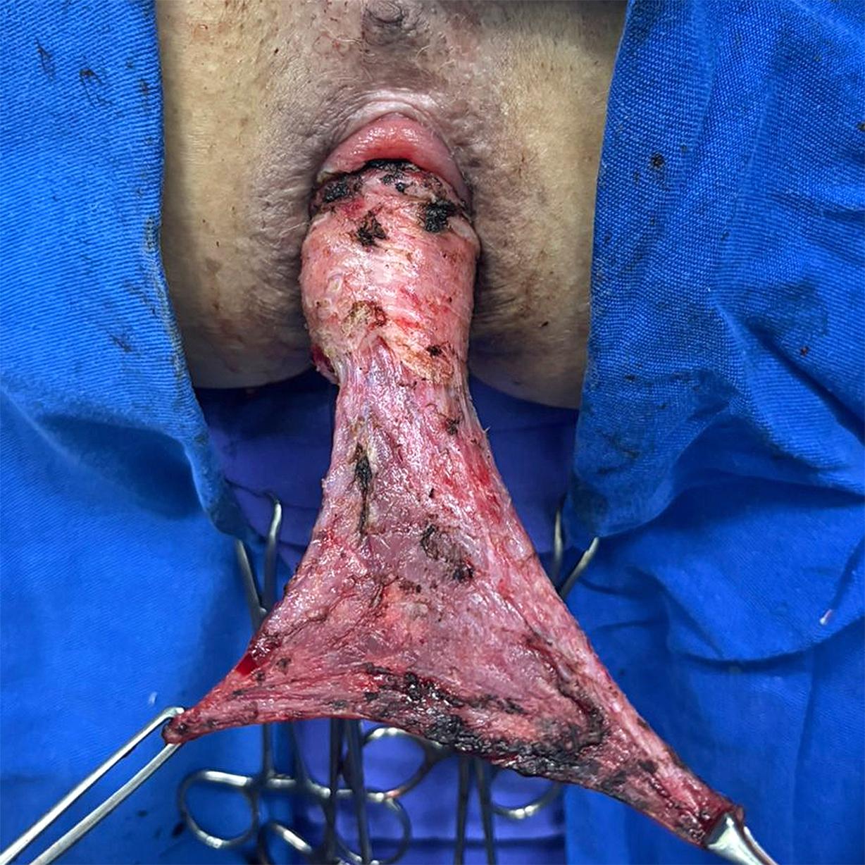 Caso Código 259B de Prolapso Retal - Case Code 259B of Rectal Prolapse 