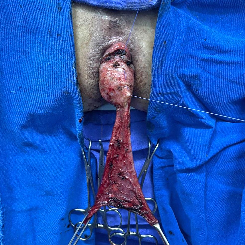 Caso Código 259C de Prolapso Retal - Case Code 259C of Rectal Prolapse 
