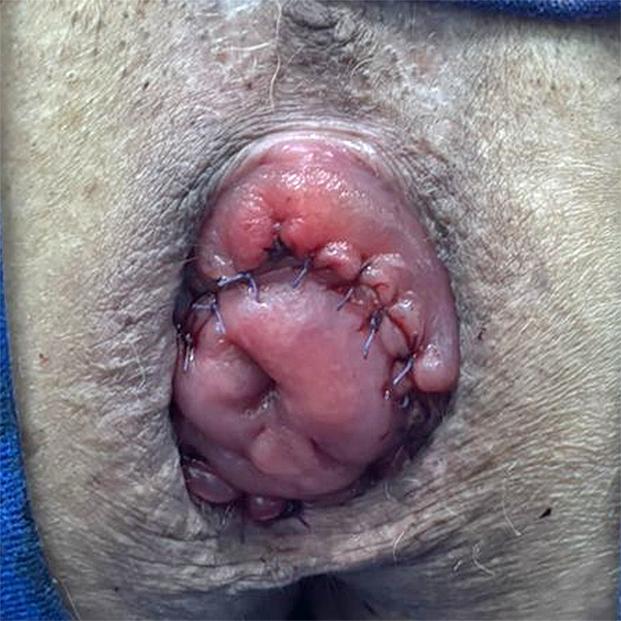 Caso Código 259D de Prolapso Retal - Case Code 259D of Rectal Prolapse 