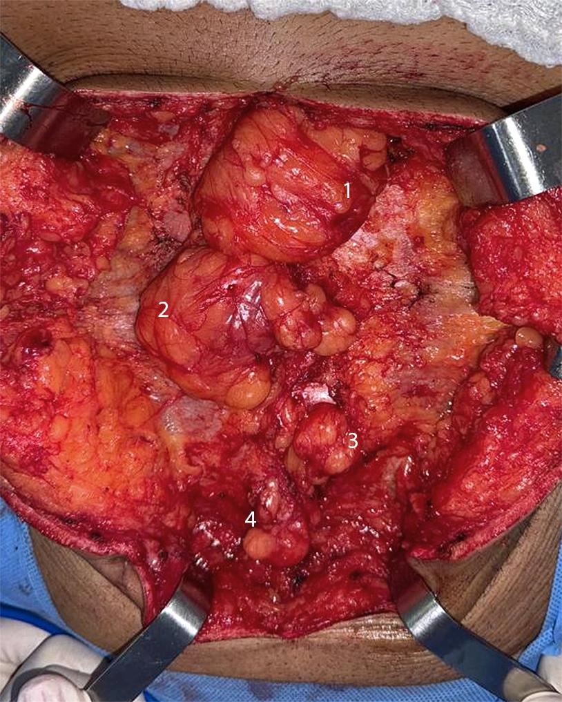 Caso Código 260A de Hérnia Epigástrica - Case Code 260A of Epigastric hernia