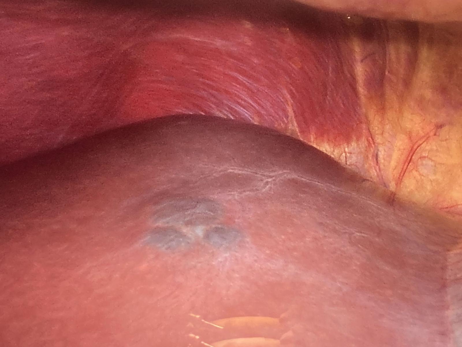 Caso Código 261A de Hemangioma hepático - Case Code 261A of Hepatic hemangiomas
